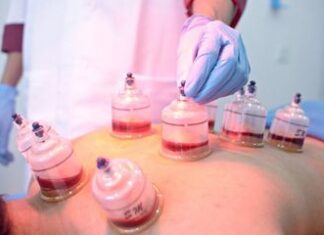 Berbekamlah Agar Sehat